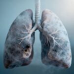Symptoms of Mesothelioma